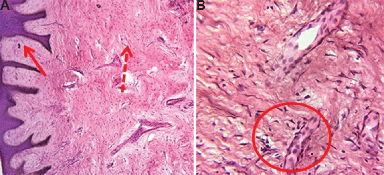 (A) Photomicrograph showing dense bundles of collagen fibres (dotted arrow) with stratified squamous epithelium (arrow) (H and E, ×10). (B) Abundance of spindle-shaped fibroblasts was seen (inside the circle) which are characteristics of fibroma (H and E, ×40).